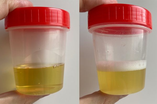 fresh vs 3 days old urine